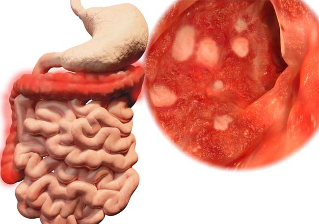 Síndrome de intestino irritable con constipación y su tratamiento